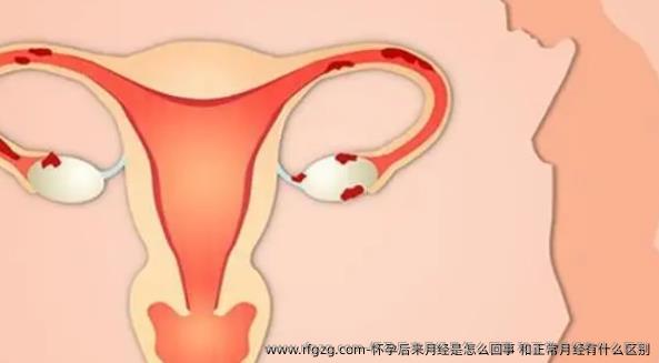 怀孕后来月经是怎么回事 和正常月经有什么区别